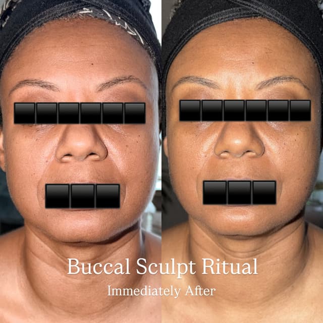 Buccal Sculpt- Model 3Pk at Very Aesthetic Skin + Brows in Franklin, TN